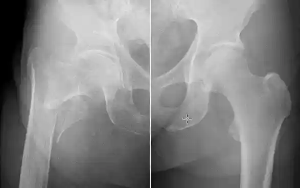 大腿骨を撮影したレントゲンの写真です。右側は骨折した大腿骨、左側は正常な大腿骨です。右側の大体骨は砕けてバラバラになっています。