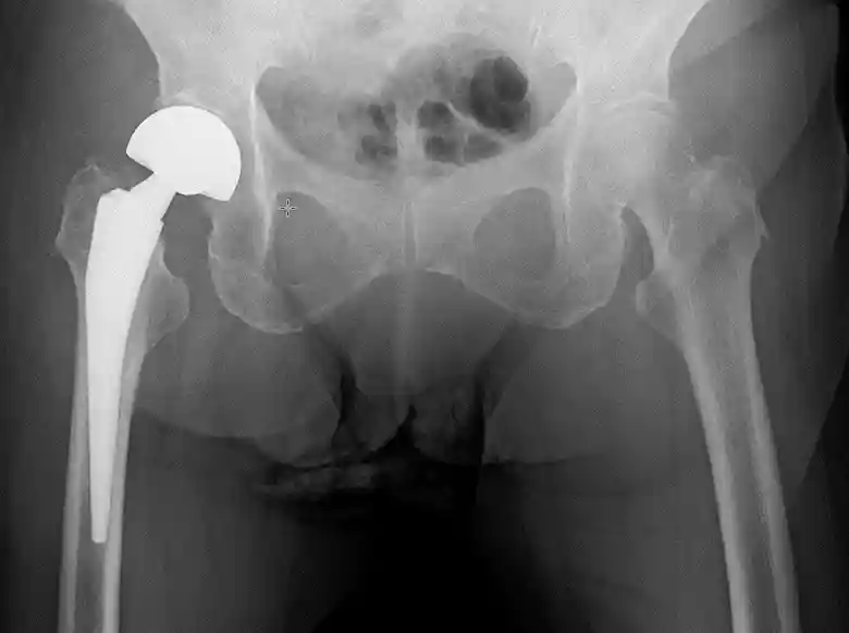 手術後の大腿骨を撮影したレントゲンの写真です。右側の骨折したところは金属性の人工骨に置き換えられています。
